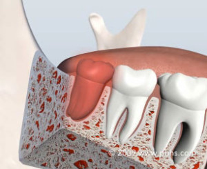 impacted wisdom tooth removal virginia